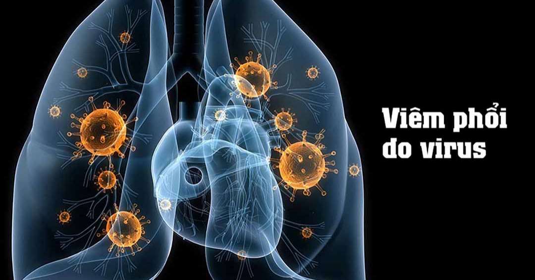 Viêm phổi do virus là gì?