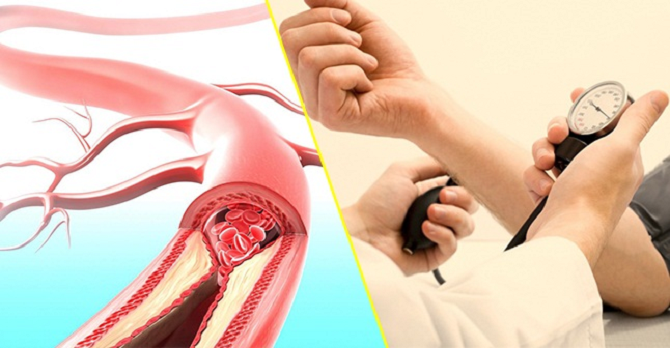 Giải pháp hiệu quả để phòng tai biến, đột quỵ ở người già - Khám chữa bệnh,  phổ biến kiến thức y học - Cổng thông tin điện tử Sở y tế